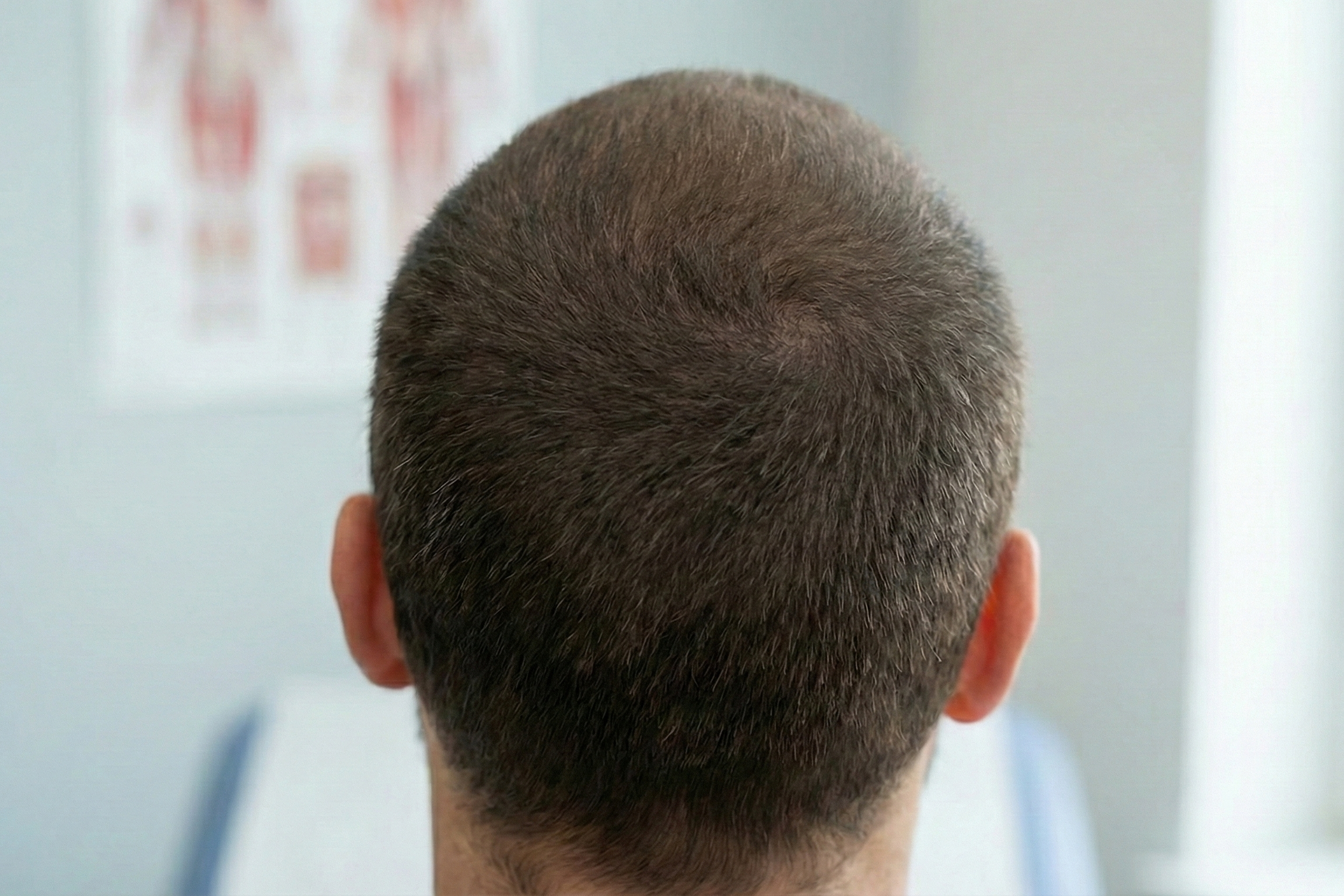 After Hair Transplant Back